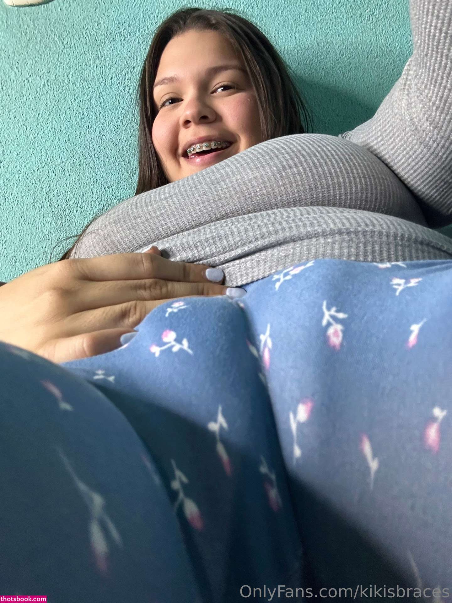 kikisbraces Photo #77